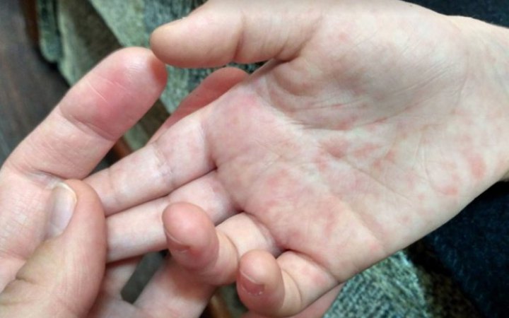 МОЗ: Торік в Україні на кір захворіло людей у 6 разів більше, ніж у 2022 році