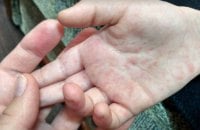 МОЗ: Торік в Україні на кір захворіло людей у 6 разів більше, ніж у 2022 році