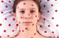 Количество заболевших корью в Киеве увеличилось до 109 человек