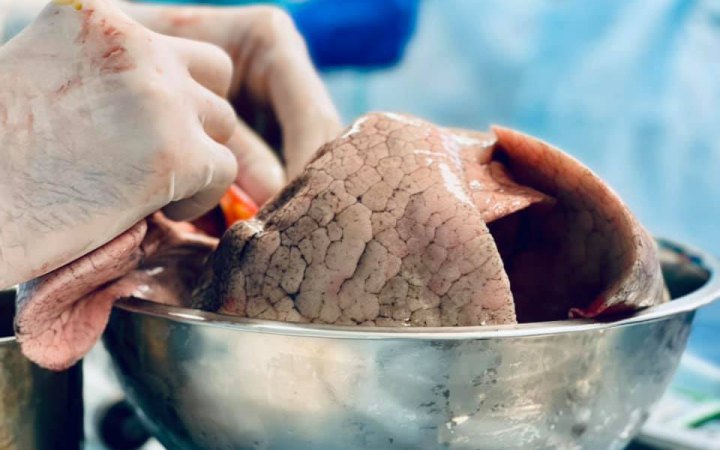 Хто активніший, той органів отримає більше: МОЗ пояснив, чому одні лікарні роблять більше пересадок за інших