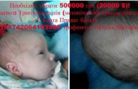 1,5-месячному малышу требуется срочная операция на черепе