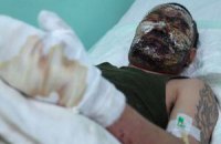 В Забайкалье собирают деньги на лечение обгоревшего на Донбассе бурята