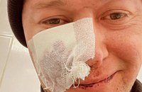 Лідер "Бумбоксу" зазнав поранення внаслідок мінометного обстрілу Києва
