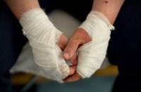 Лише 11% госпіталізованих дітей з опіками в Україні отримують реабілітацію, — дослідження
