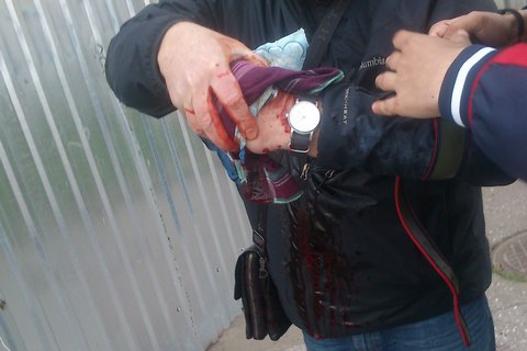 В Одессе на Куликовом поле в руках участника траурной акции взорвалась лампадка