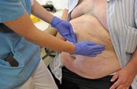 Ученые нашли способ быстрее сжигать жир в организме