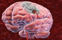 Риск инсульта у диабетиков утраивается каждые десять лет