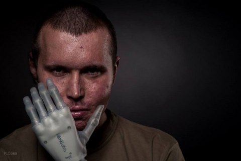Бионические протезы рук будут устанавливать в Украине со следующего года
