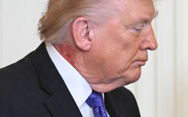 Здоров'я Трампа знову під питанням: Білий дім пояснив висип на шиї президента