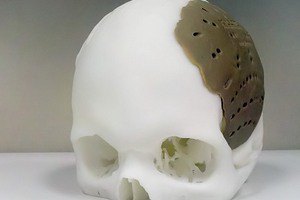 Американцу заменили кости черепа при помощи 3D-принтера