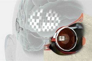 Ученые успешно испытали бионический глаз, вживленный человеку