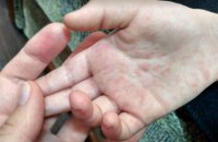 С начала года в Украине 15 человек умерли от осложнений кори