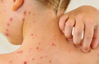 В Одесской области корью заболели более 70 детей