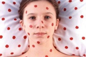 За сутки число заболевших корью увеличилось на 85 чел.
