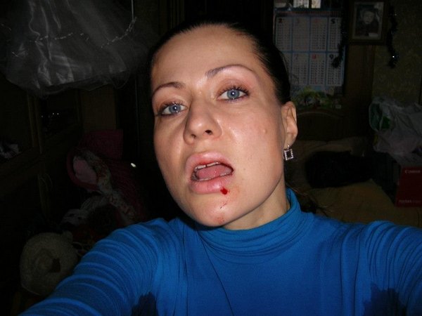 Елена Паперник опубликовала фотографию с выбитым зубом